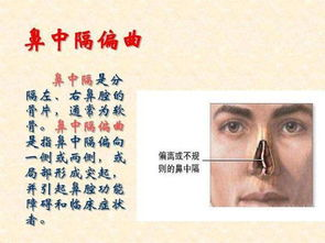 一、鼻中隔骨骨折的定义与影响