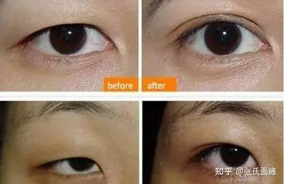 眼睑下垂伤残等级判定及解决方案解析