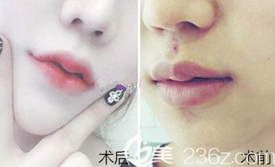 一、术后恢复不当导致厚唇复发