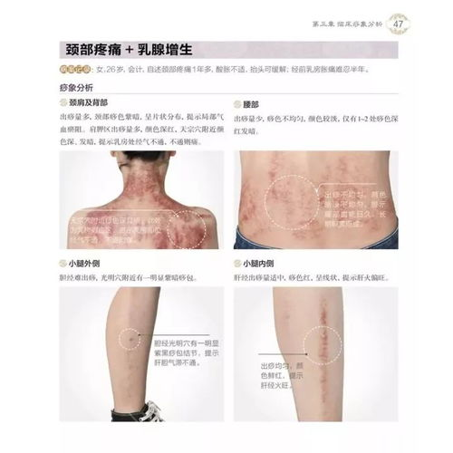 一、红痣的基本特征