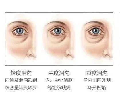 一、眼袋形成的原因及影响