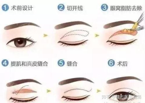 一、双眼皮手术案例图片展示