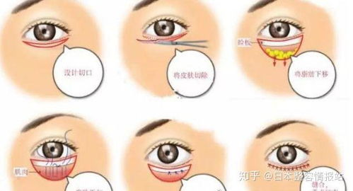 一、认识眼睑下至图片的重要性