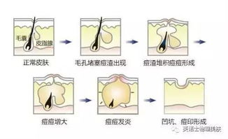 一、痘坑修复水的成分与作用原理