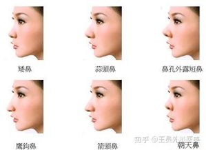 一、玻尿酸隆鼻的原理及鼻梁变宽的原因
