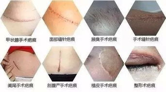 一、疤痕贴的作用与选择标准