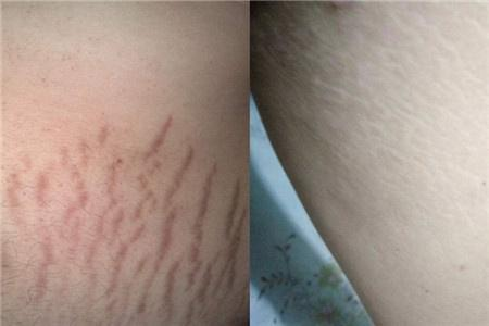 一、什么是膨胀纹？