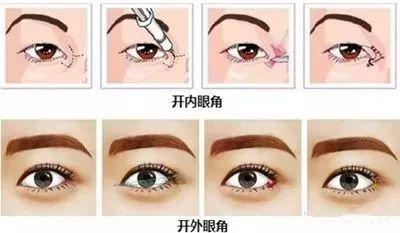 一、开眼角手术简介