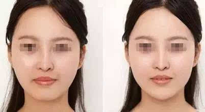 一、整容下巴手术简介